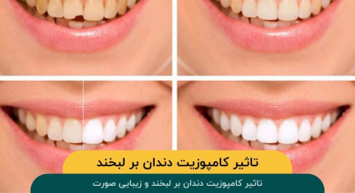 تاثیر کامپوزیت دندان بر لبخند و زیبایی صورت